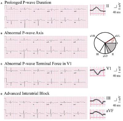 P Wave Indices—Advancing Our Understanding of Atrial Fibrillation-Related Cardiovascular Outcomes